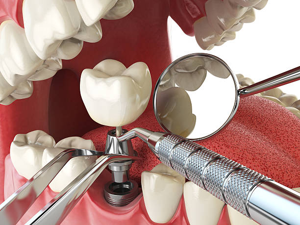 Best Emergency Root Canal Treatment in Henderson, NV